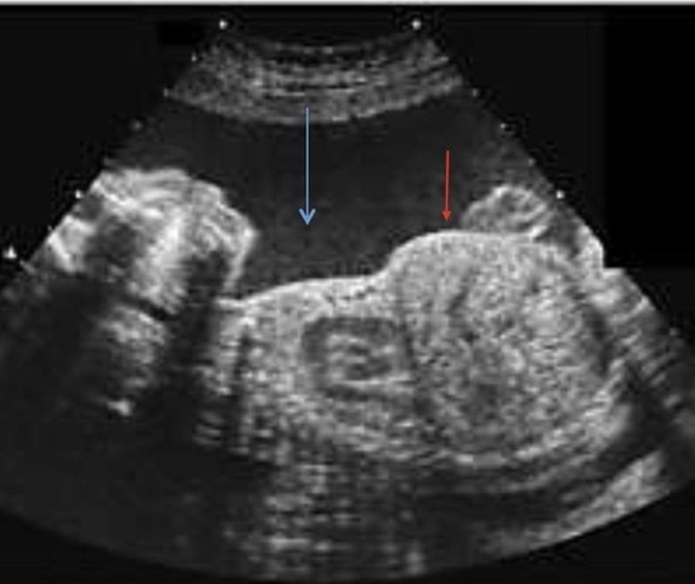 <p>Lungs do not form properly</p><p>Small lung size</p><p>Bell-shaped chest</p><p>Oligohydramnios</p><p>Skeletal Dysplasia</p><p>Pleural Effusion or Hydrothorax</p><p>Congenital Bronchial Atresia</p><p>Pulmonary Sequestration</p>