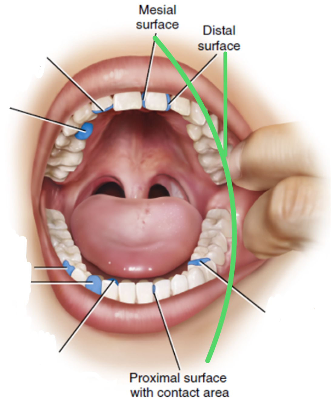 <p>Mesial and distal surfaces between adjacent teeth </p>