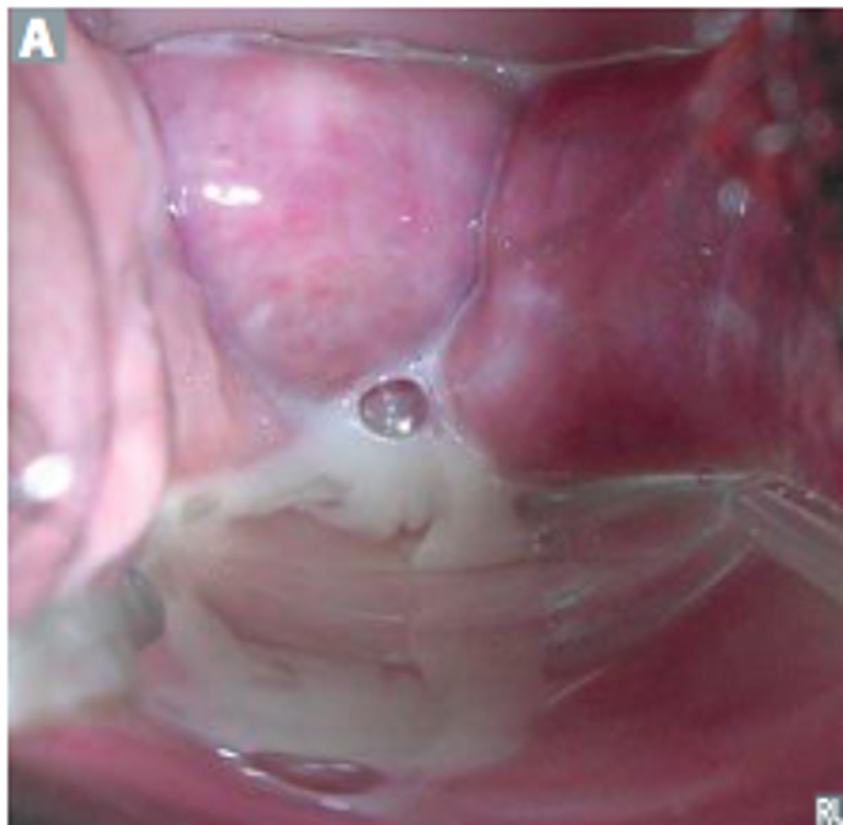 <p>(spontaneous) discharge of milk</p>