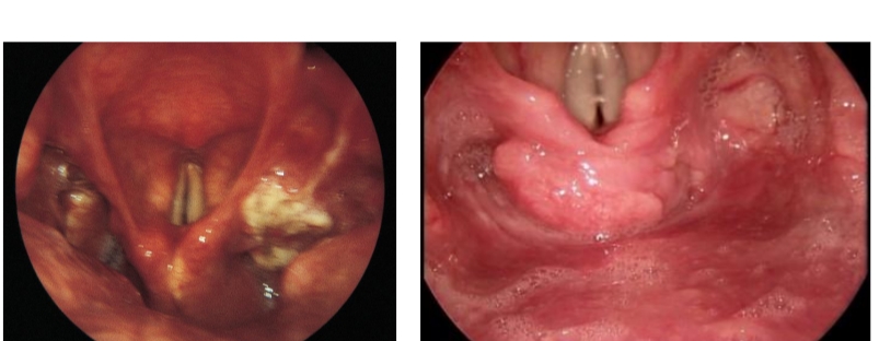 <p>Slechte prognose - vaak is eerste symptoom pas laattijdig een halsklierzwelling!<br>Snelle metastasering<br>Kleine tumoren geven weinig symptomen<br>Grotere tumoren: dysfagie, globusgevoel, geref.otalgie<br>Invasie van de larynx: heesheid of stridor</p>