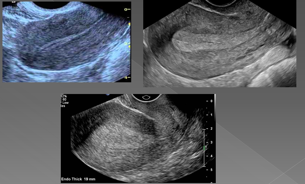 <p>In premenopausal women, if the endometrium measures more than ____, hyperplasia is suggested </p>