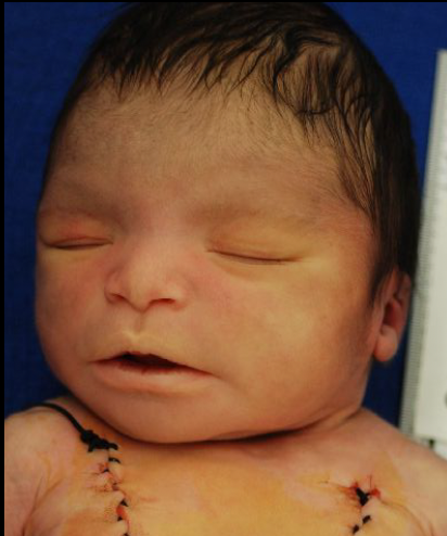 <p>cerebellum does not develop normally</p>