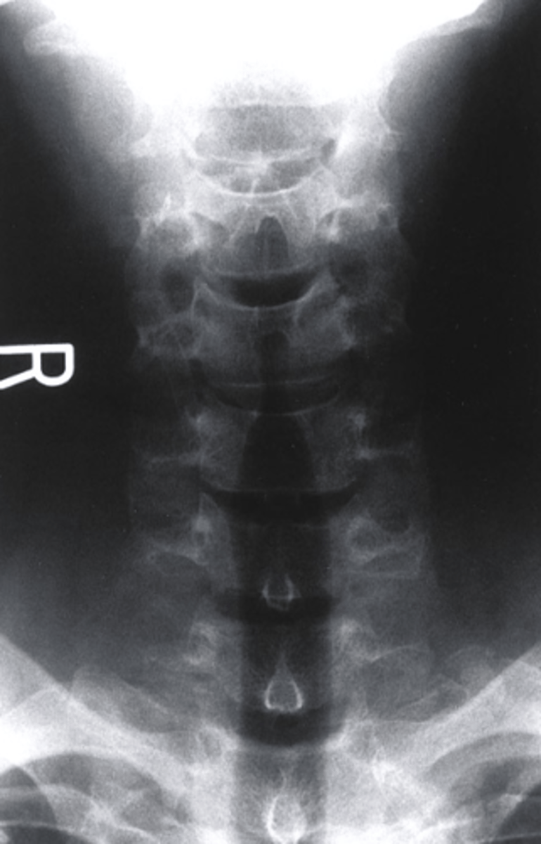 <p>what view is this?</p><p>a. AP Lower C Spine</p><p>b. AP Lumbar Spine</p><p>c. R oblique</p><p>d. L Lateral</p>