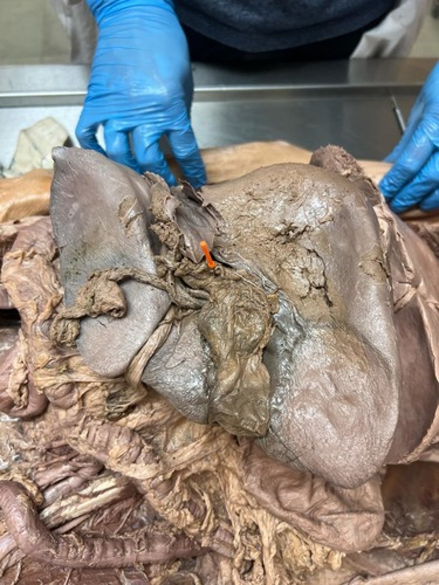 <p>neck of gallbladder</p>