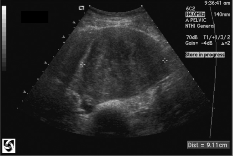 <ul><li><p>5% of all ovarian tumors</p></li><li><p><span style="color: #a700ff">ages 50-60 </span></p></li><li><p>usually unilateral - but may be multiple</p></li><li><p>appear hypoechoic with shadowing</p></li><li><p><span style="color: #ff0000">5-16 cm</span></p></li><li><p>can also be associated w/ <span style="color: #ff0000">Meigs Syndrome</span></p></li></ul><p></p>