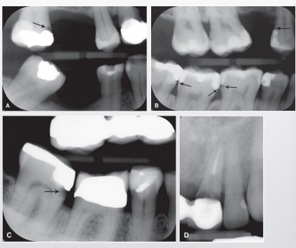 <p>BWX due to beam angulation</p>