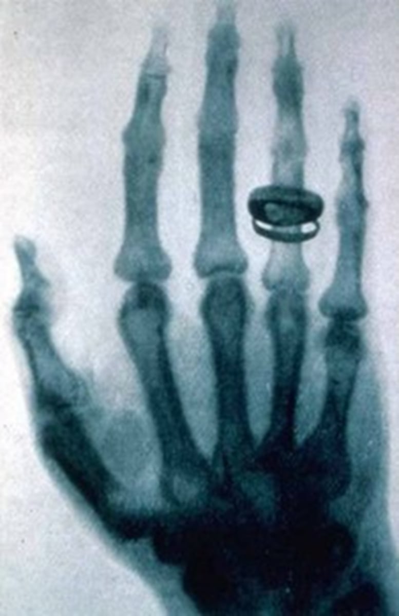 <p>- Wilhelm Conrad Roentgen discovered Xrays in 1895</p><p>- His wife was said to be his first "patient"</p><p>- Xrays were first used in a medical application in 1896</p><p>- For the first time doctors could see what was going on inside a patient</p>