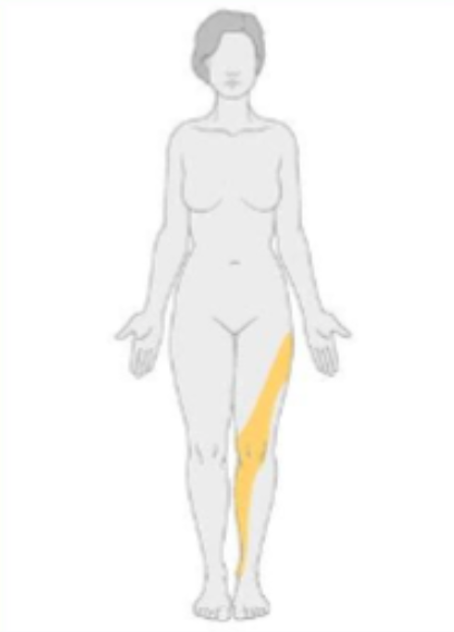 <p>what type of neuropathy would have the following distribution?&nbsp;</p>