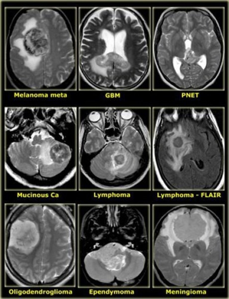 <p>A benign tumor composed of the cells of the meninges.</p>