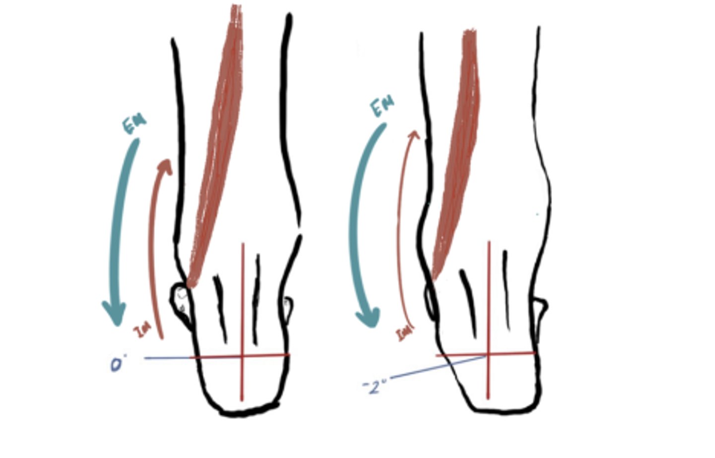 <p>IM: Inversion (Tibialis posterior)</p><p>EM: Eversion </p><p>IM</p>