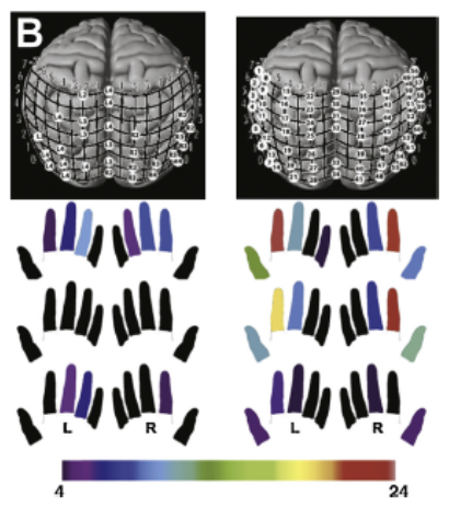 <p><u>functional modular plasticity=</u> what's happening at the network level, as opposed to the individual/cellular level or what’s happening at individual synapses</p><ul><li><p><strong><u>an ***area that previously ***processed a specific type of sensory input now ***receives input from another sensory source</u></strong> (i.e., <strong><u>***intro of new inputs into a ***representational brain region that’s been ***deprived of its main inputs</u></strong>)</p></li><li><p>often the <strong><u>result of ***decreased sensory input to a cortical region in the ***absence of the typical sensory input</u></strong></p></li><li><p><strong><u>***brain region is ***“recruited” by other sensory modalities</u></strong></p></li><li><p>e.g., <em>tactile info being processed in the occipital cortices for people who are blind</em></p></li></ul><p></p>