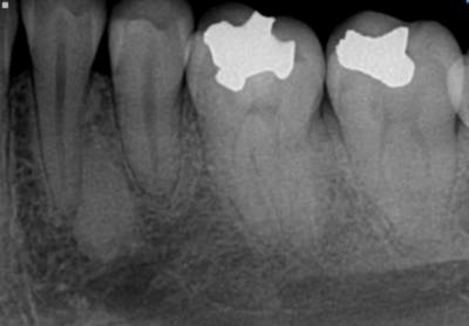<p>• Well defined periphery but may blend with trabeculae of surrounding bone </p><p>• No effect on teeth but rarely associated with root resorption</p>
