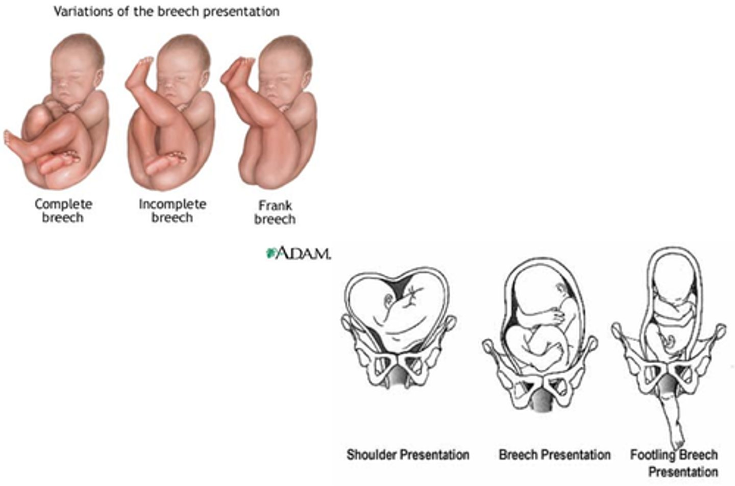 <p>Fetal position in relation to the maternal pelvis can impact labor progress is not optimal</p>