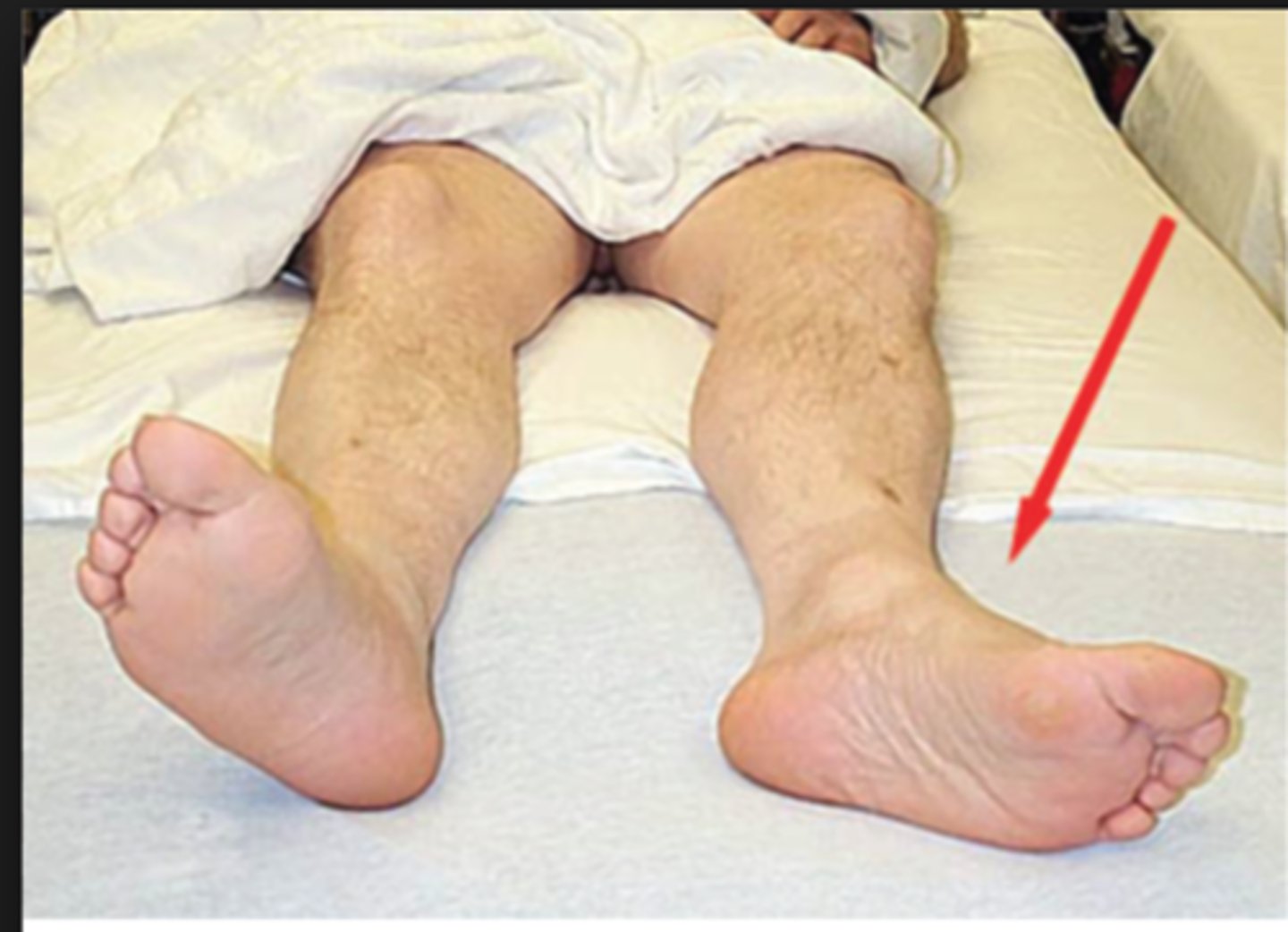 <p>Affected limb will be shortened and laterally (externally) rotated</p>