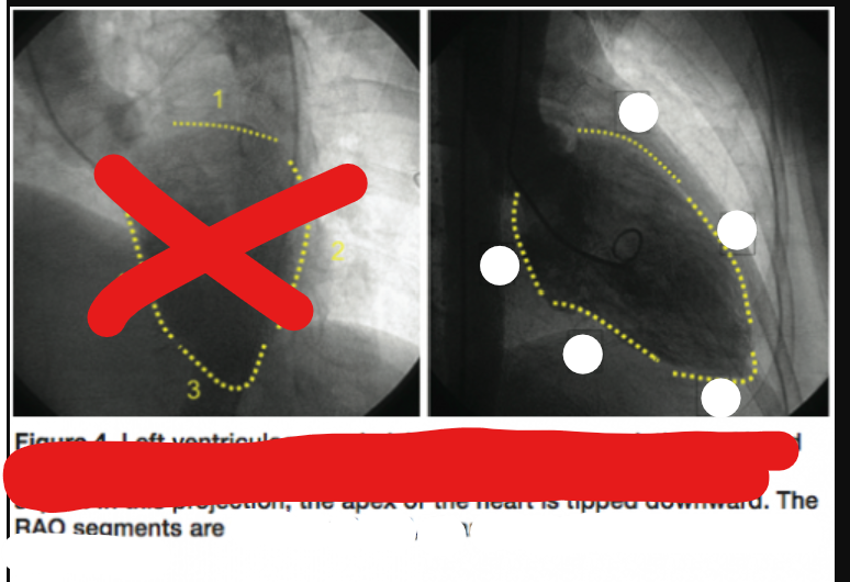 <p>label the heart surface in this RAO angiographic image</p>