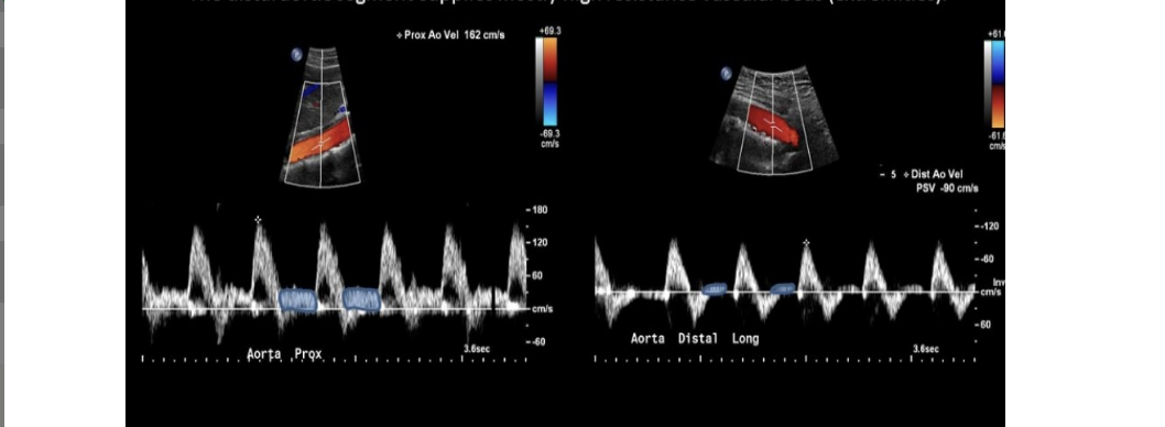 <p>resistance to flow ___ as <strong><u>blood travels distall</u></strong>y through the abdominal aorta</p><p>.</p><p>a) increases</p><p>b) decreases by 50%</p><p>c) decreases slightly</p><p>d) remains constant </p>