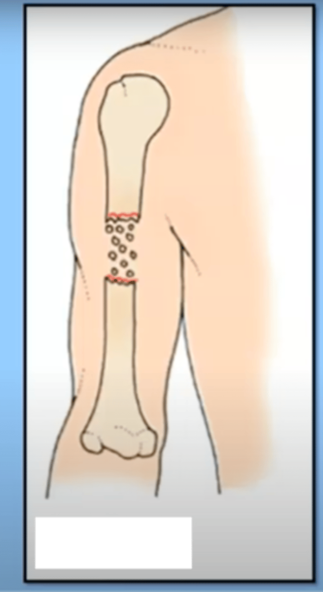 <p>fracture in which the bone is splintered or crushed</p><p>-multiple fragments</p><p>-just 2 is not, that is clean break</p>