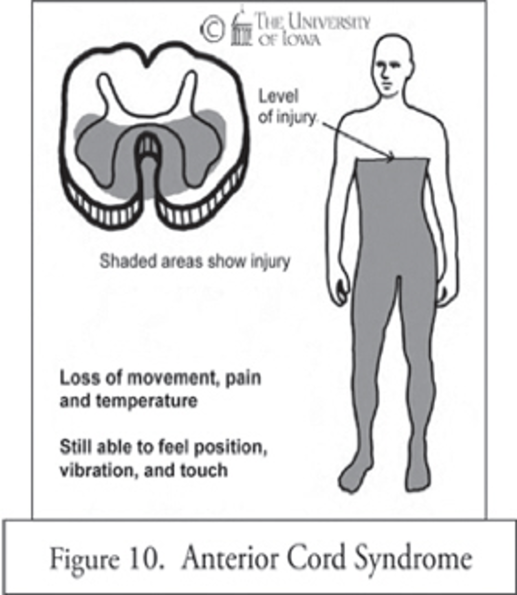 <p>o Anterior spinal artery is damaged -> decreased blood flow</p><p>o Results from flexion injury</p><p>o Leads to motor paralysis and loss of sensation below injury</p>