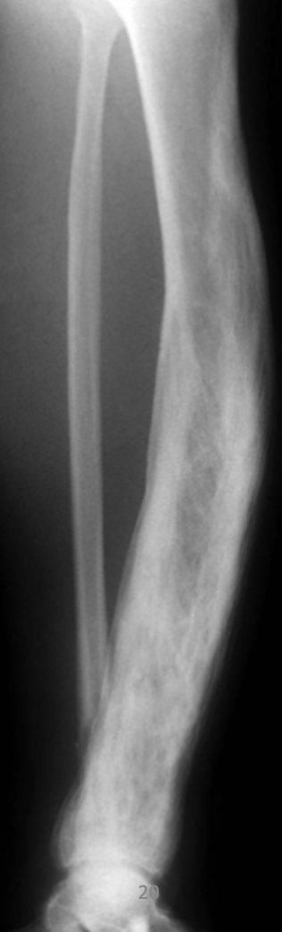<p>What is this xray showing? What disease?</p>