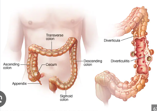 <p><span style="font-family: Droid Sans Mono, monospace">DIVERTICULOSIS</span></p>