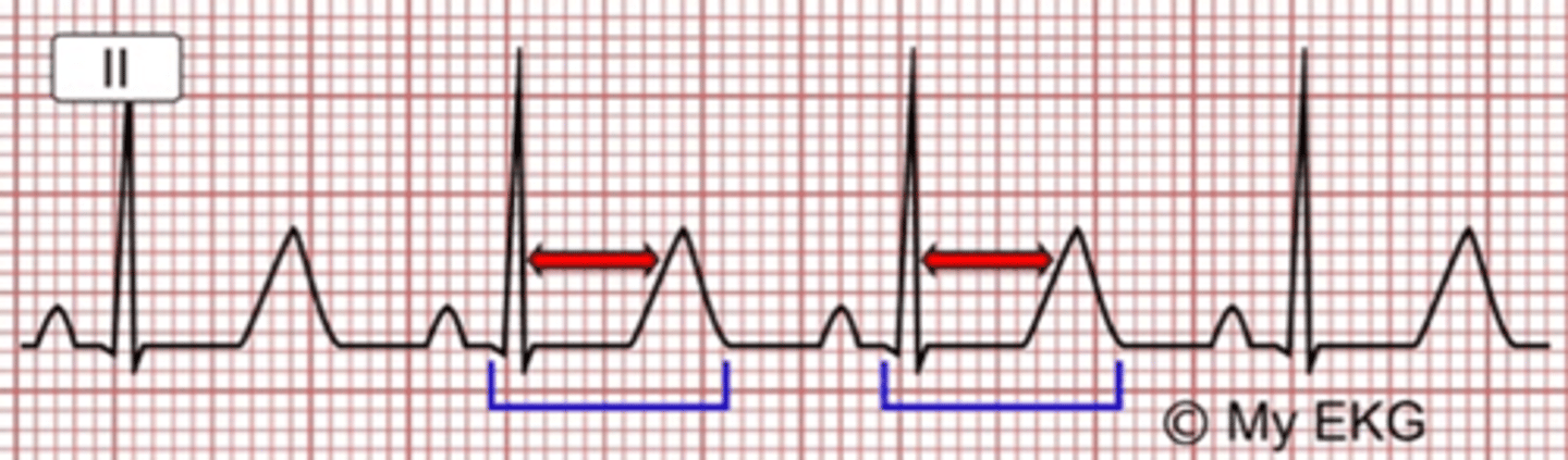 <p>prolonged QT interval and T wave abnormalities</p>