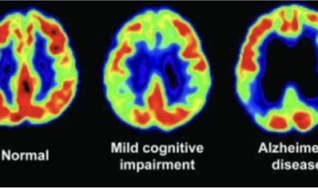 <p><span><mark data-color="green">Positron Emission Tomography:</mark> </span>Observes metabolic processes in the brain by detecting the gamma rays.</p>