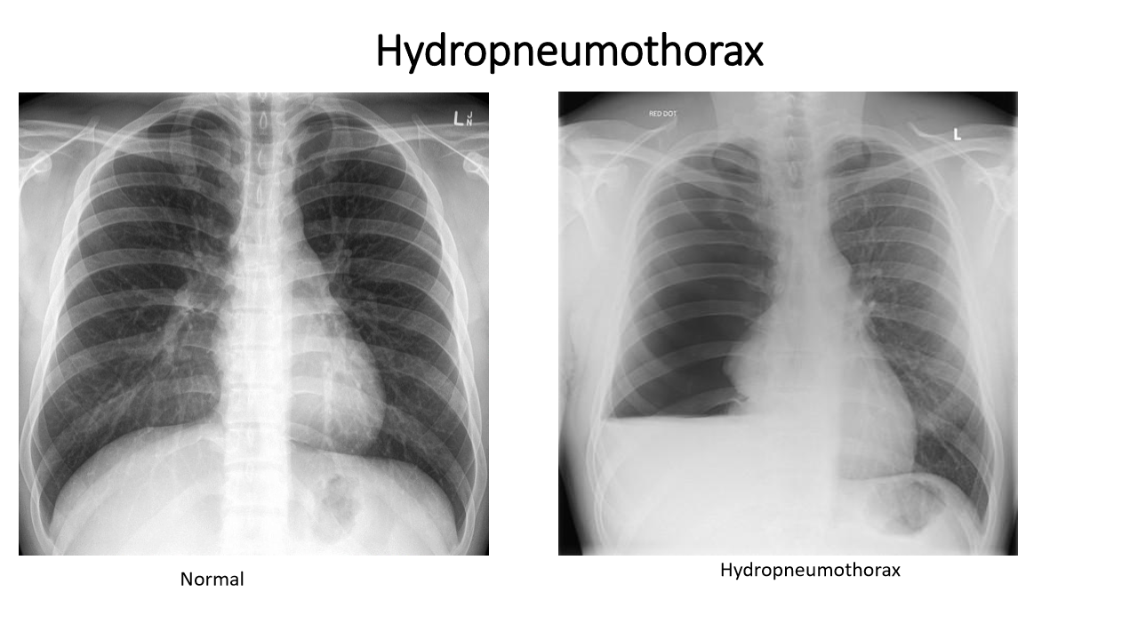 <p>hydropneumothorax (air AND water in pleural space)</p>