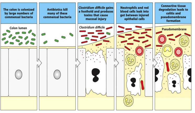 <ul><li><p>colon is colonized by large # of commensal bacteria </p></li><li><p>antibiotics kill many of these commensal bacteria </p></li><li><p>C.Diff gains a foothold and produces toxins that cause mucosal injury</p></li><li><p>neutrophils and red blood cells leak into gut btw injured epithelial cells </p></li><li><p>connective tissue degraded lead to colitis and pseudomembranous formation </p></li></ul><p></p>