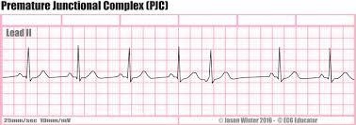 <p>1. Irregular depending on underlying rhythm and/or # of PJCs 2. Rate: depends on underlying rhythm 3. P wave: inverted, may proceed, follow or be buried by QRS complex 4. PR interval: depends on location of P wave 5. QRS complex (WNL)</p>