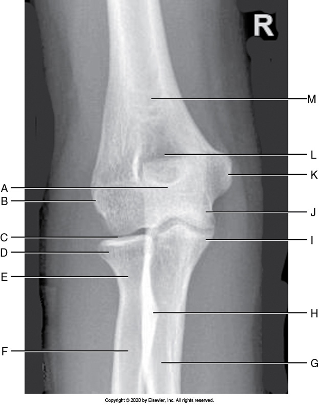 <p>Identify the labeled "K" anatomy in the image below:</p><p>Radial head</p><p></p><p>Medial epicondyle</p><p>&nbsp;</p><p>Lateral epicondyle</p><p>&nbsp;</p><p>Olecranon</p>