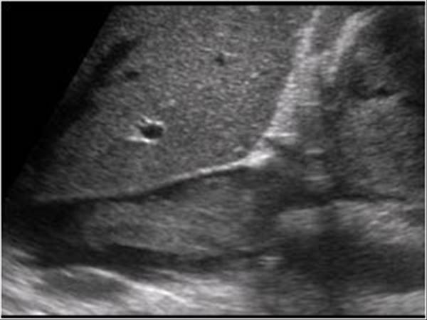 <p>The mass in the IVC on the image above is most likely consistent with which of the following diagnoses?</p><ul><li><p>Rhabdomyosarcoma</p></li><li><p>Myxoma</p></li><li><p>Infiltrative renal cell carcinoma</p></li><li><p>Angiosarcoma</p></li></ul><p></p>