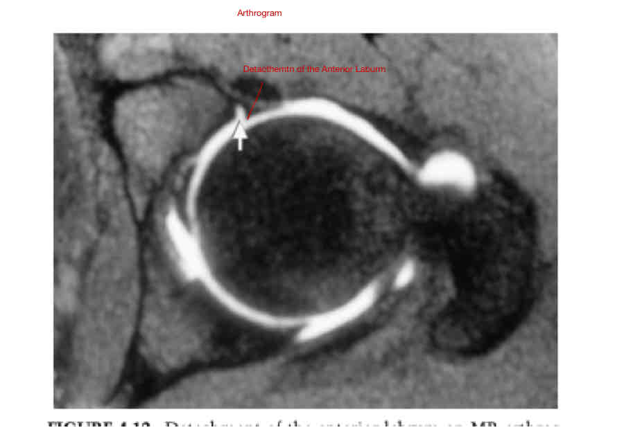 <ul><li><p>S/S</p><ul><li><p>Hip and Groin Pain (90%)</p><ul><li><p>Increased w activity </p></li></ul></li><li><p>Slicking/Popping </p></li><li><p>Giving Way</p></li><li><p>Stiffness</p></li></ul></li><li><p>Pnful Positions</p><ul><li><p>Flexion </p></li><li><p>Adduction </p></li><li><p>IR</p></li></ul></li></ul><p></p>