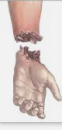 what was once connected to a body part is no longer connected

