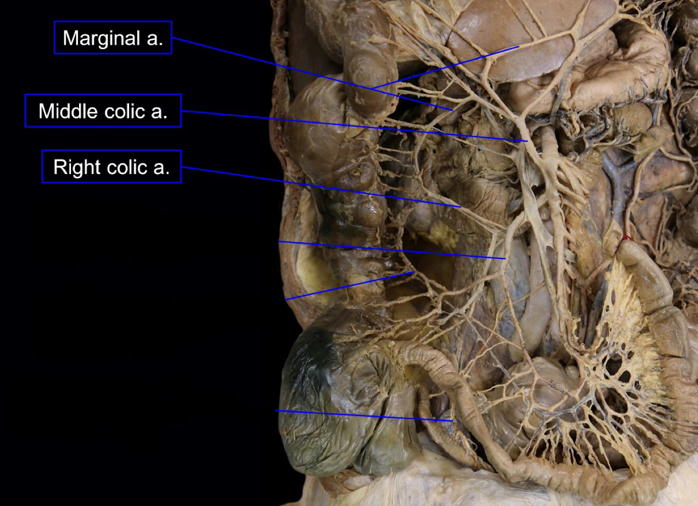 <p>A). marginal artery<br>B). right colic artery, middle colic artery, and left colic artery<br>(left colic artery not shown)</p>