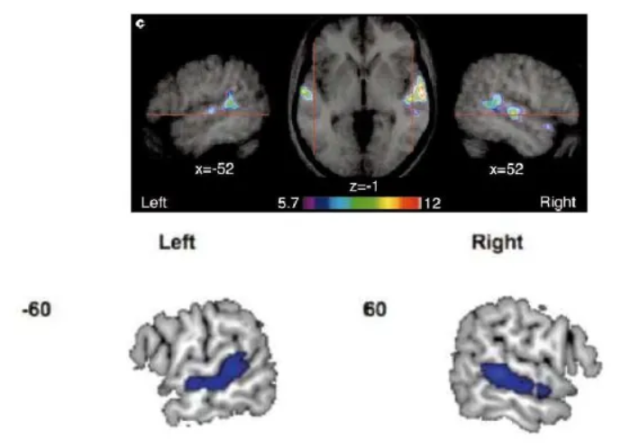<p>Overlap in a network of brain regions, primarily within the superior temporal cortex and the inferior frontal gyrus across both the left and right hemispheres.</p><p>Key Overlapping Regions:</p><ul><li><p><strong><span>Superior Temporal Sulcus/Gyrus (STS/STG):</span></strong><span> These regions in the temporal lobes are crucial for the initial auditory analysis of sound. They are specialized for processing human voices as a class of auditory objects and are also involved in the early sensory analysis of vocal features that contribute to accent perception.</span></p></li><li><p><strong><span>Inferior Frontal Gyrus (IFG):</span></strong><span> This area, which includes Broca's area on the left side, is involved in speech production and motor planning. It is also recruited during the perception of accents, particularly unfamiliar ones, suggesting the brain uses motor regions to help interpret challenging or unfamiliar speech sounds.</span></p></li><li><p><strong><span>Insula and Rolandic Operculum:</span></strong><span> The left anterior insula and the operculum (the part of the frontal lobe covering the insula) are involved when individuals deliberately change their voice or process variations in speech articulation, which is central to an accent.</span></p></li><li><p><strong><span>Supplementary Motor Area (SMA) and Cerebellum:</span></strong><span> These areas, part of the brain's speech motor control network, also show overlap. The cerebellum, in particular, is involved in the precise timing and coordination of speech movements (phonation and articulation) that characterize an accent. The SMA is also involved in the initiation and control of speech.&nbsp;</span></p></li></ul><p></p>
