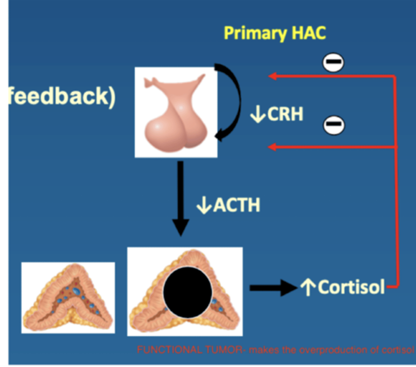 <p>hyperadrenocorticism caused by a functional adrenal tumor. it can be benign (adenoma) or malignant (adenocarcinoma).</p><p>it causes the ↑ release of cortisol and therefore the ↓ release of CRH and ACTH (due to negative feedback)</p>