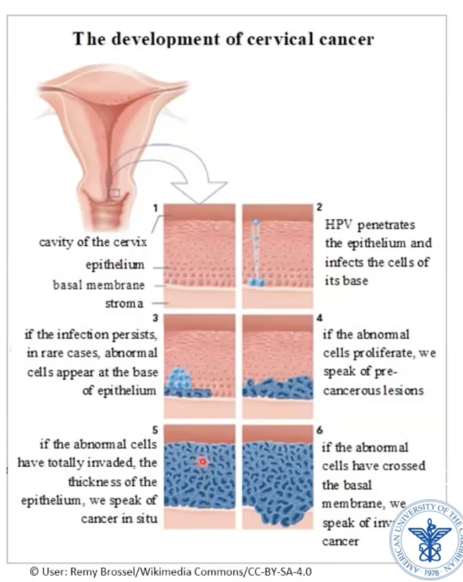 <ul><li><p>Starts in transition zone - transition from endocervix to exocervix</p><ul><li><p>Columnar → squamous</p></li></ul></li><li><p>Starts as dysplasia (not full thickness atypic)</p><ul><li><p>Progresses to squamous cell carcinoma in situ</p></li><li><p>Progresses to invasive squamous cell carcinoma</p></li></ul></li></ul><p></p>