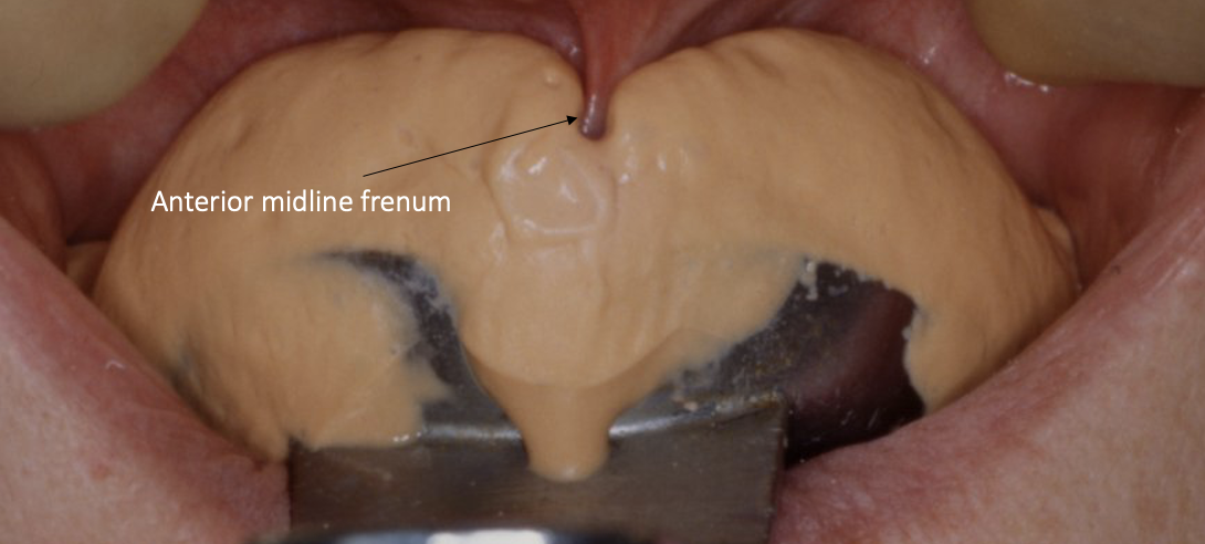 <ul><li><p>the superior/ inferior labial frenum</p></li></ul><p></p>