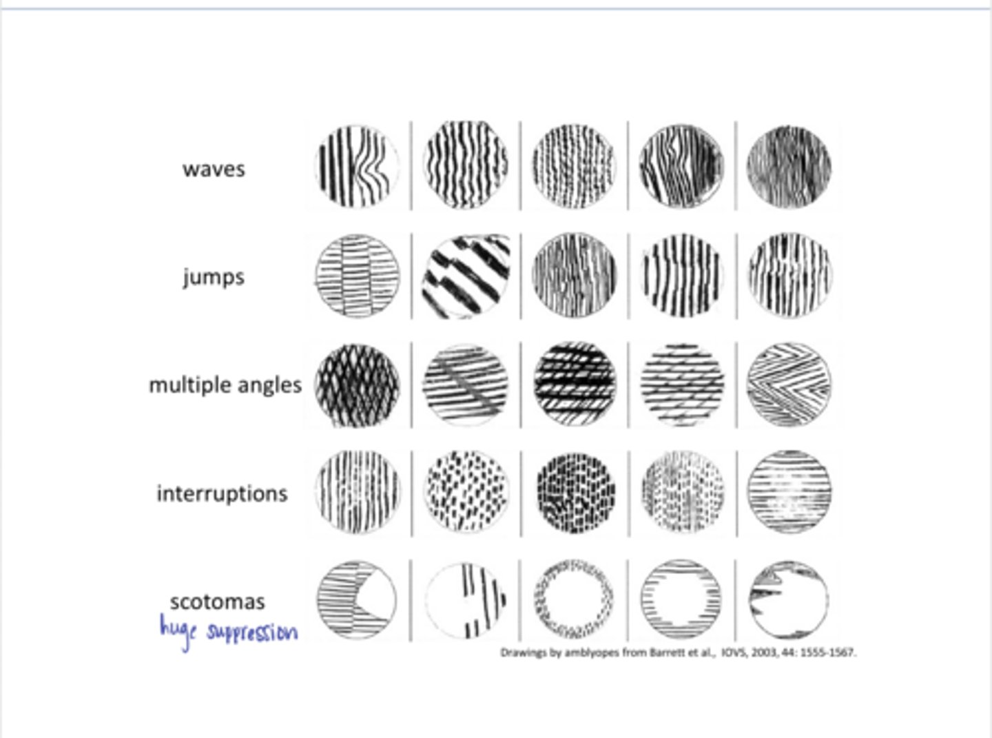 <p>What are the perceptual consequences of strabismic amblyopia?</p>