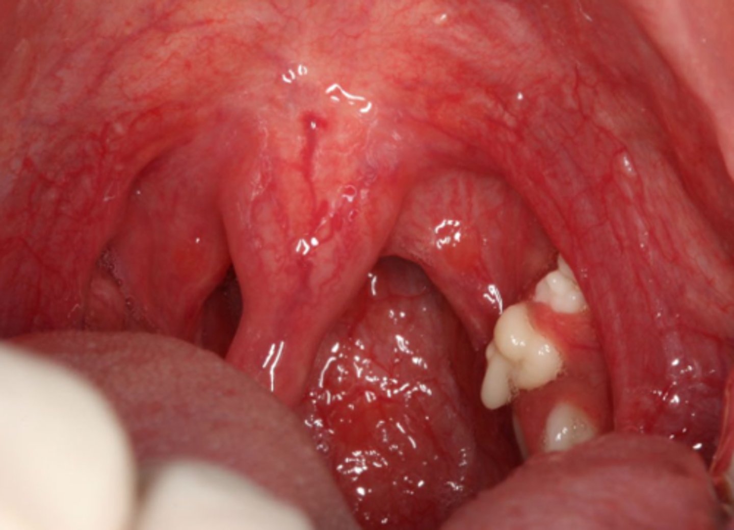 <p>tonsillar crypts filled w/ debris (surrounding tissues is uninflamed)</p>
