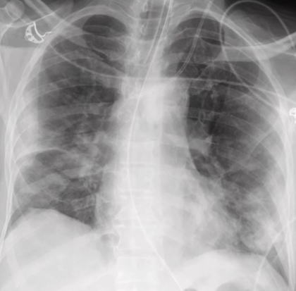 <p>multiple bilateral patchy consolidations or opacities</p>