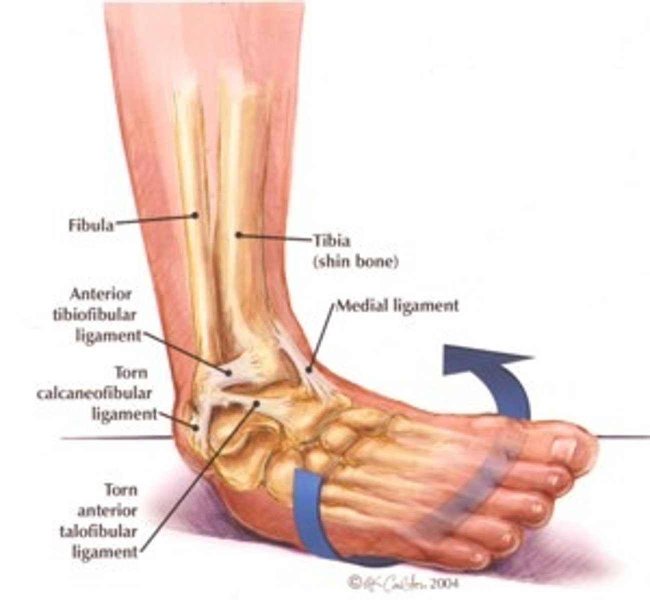 <p>Inversion + plantarflexion during weight bearing</p>