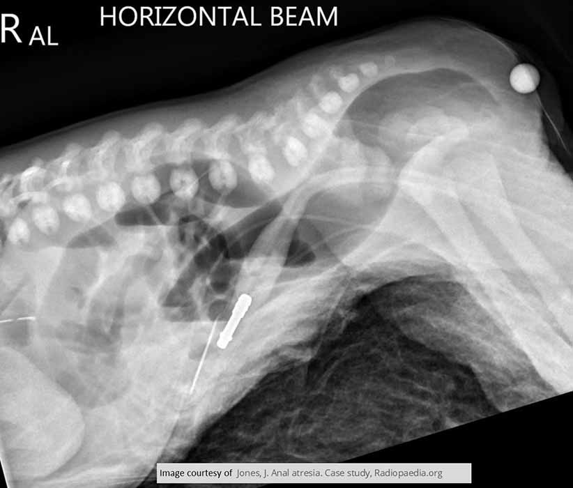 <p>How is imperforate anus categorized anatomically?</p>
