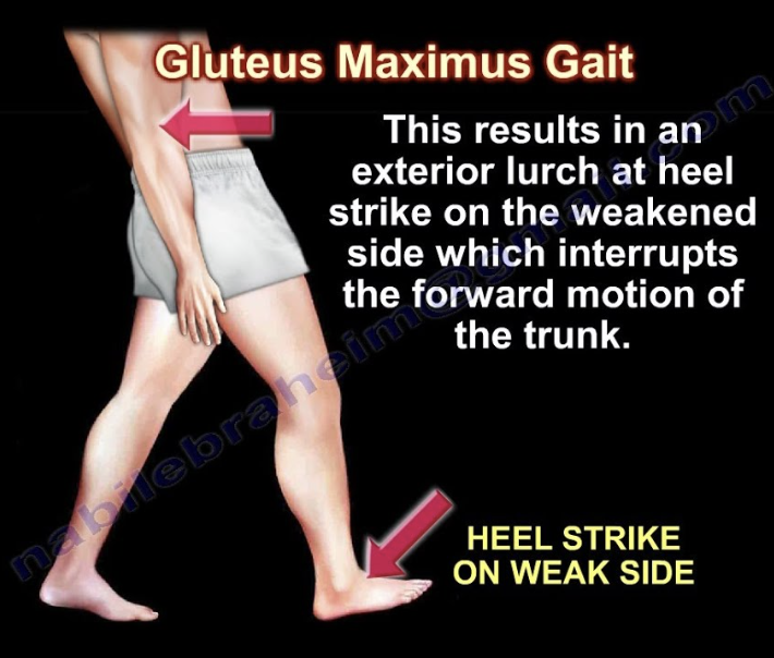<p><strong>Impairment: </strong><span style="color: blue">Gluteus maximus weakness</span><br><strong>Deviation/Compensation: </strong><span style="color: red">Gluteus maximus gait</span> — trunk leans backward to lock hip into extension</p>