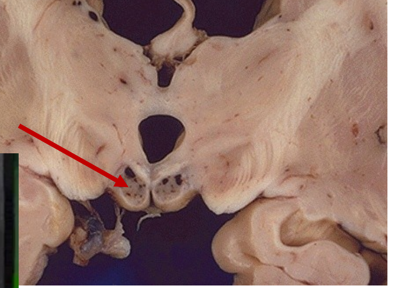 <p>_____ syndrome results in memory loss caused by lack of ______ especially in chronic alcoholics, patietns may ______ or fill in gaps in memory with falsification, this can cause lesions to the _____ ______ </p>