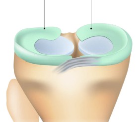 <p>Which type of synovial joint structure has:</p><ul><li><p>Cushion the joint</p><ul><li><p>Fibrocartilage (articular disc)</p></li><li><p>Sits between bones</p></li><li><p>Ex. knee</p></li></ul></li></ul><p></p>