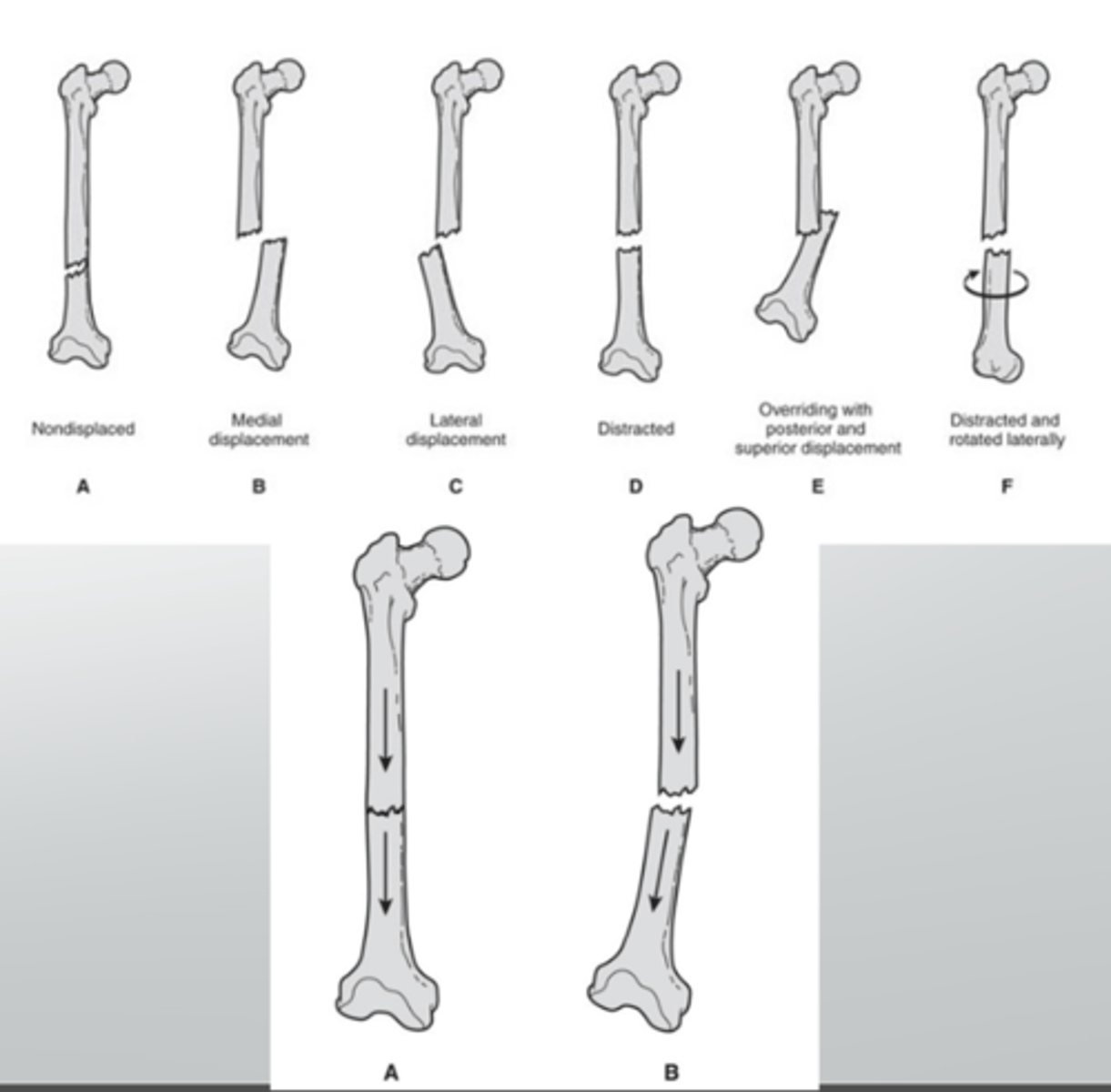 <p>Alignment</p>