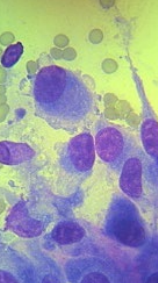 <ul><li><p><span style="color: red"><strong>Benign:</strong></span> fibroma, lipoma</p></li><li><p><span style="color: red"><strong>Malignant:</strong></span><strong> </strong>fibrosarcoma, liposarcoma</p></li><li><p><strong><u>Singular, elongate</u></strong><u> </u>cells: may be aggregates</p><ul><li><p><strong><u>Cytoplasmic tails</u></strong></p></li></ul></li><li><p><strong><u>Does not exfoliate well</u></strong></p></li></ul><p></p>