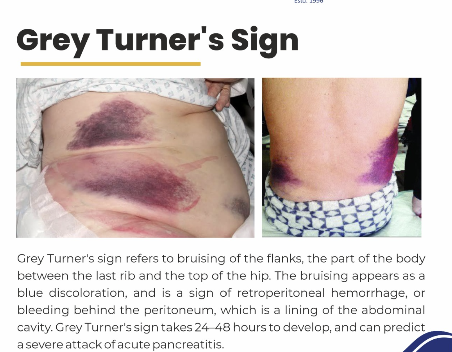<p>discoloration of the skin of flank areas due to bleeding from necrotic vessels</p><p>seen in hemorrhagic pancreatitis </p>