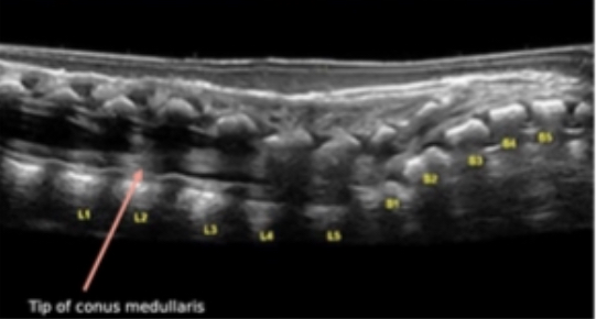 <p>At what level does the conus end?</p>